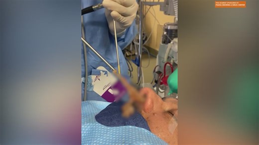 Getting rid of the 'World's Largest Booger' with The Pasha Snoring & Sinus Center