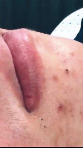 Treating Inflamed Nose: Causes and Remedies