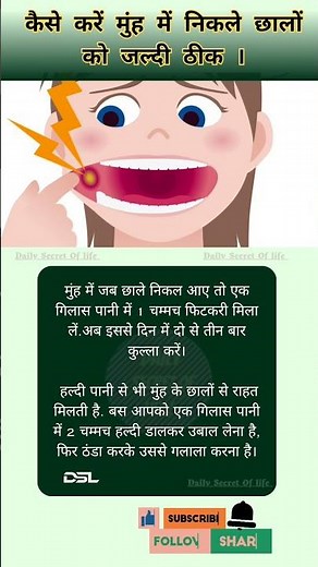 #mouthulcer #mouthulcertreatment #mouthulcers #muhkechale #healthtips #health #youtube #trending