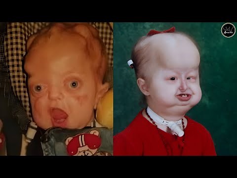 10 PEOPLE WITH RAREST DISEASE IN THE WORLD