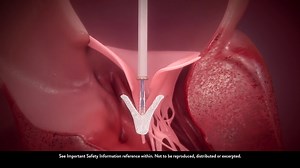 MitraClip G4 Product Animation Video