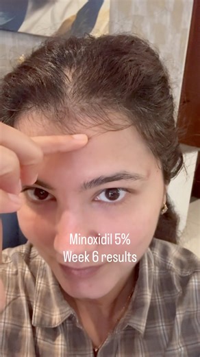 Results with Minoxidil 5% at 6 week mark!!
