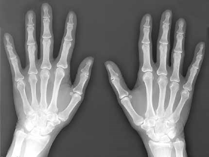 X-ray (Radiography) - Bone