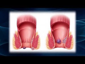 Hurting From Hemorrhoids