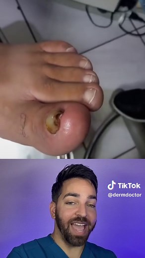 Real life @Podologiafungosmicose | wound infested with maggots humans