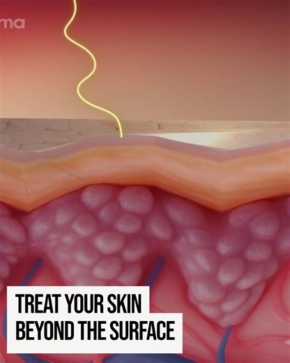 Real transformation is an inside job ✨ We often rely on high-street creams hoping for a miracle, but the truth is, most over-the-counter products only sit on the surface. To make changes in the way the skin behaves, and to treat issues such as deep set pigmentation, we have to treat the skin’s architecture beneath the surface. Here is how we target the deeper layers to spark real change: 💧 Injectable Hydration (Skinvive): This goes where no moisturizer can. By injecting micro-droplets of hyalur