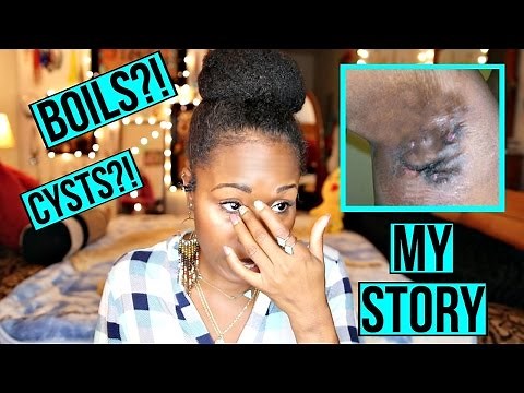 Boils Under My Armpits & Inner Thighs?! | My Hidradenitis Suppurativa HORROR STORY