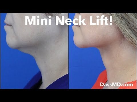 Mini Neck Lift Tightens Skin Fixes Double Chin - Beverly Hills Plastic Surgeon