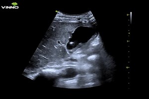 Percutaneous Transhepatic Gallbladder Drainage (PTGBD) in the treatment of senile acute cholecystitis has the advantages of easy operation, high success rate, good treatment effect, and fewer complications. With the development of global aging, the incidence of acute cholecystitis in the elderly has increased significantly. Due to the decline of physical function and other complications in elderly patients, the mortality and complication rates of acute cholecystectomy are high. Even with cholecy