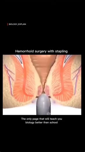 medical / biology explain on Instagram: "Stapled hemorrhoid surgery is a modern, minimally painful treatment for piles that focuses on fixing the root cause instead of cutting the hemorrhoids directly. In this procedure, doctors use a special circular stapling device to gently lift the fallen hemorrhoidal tissue back to its normal position inside the rectum and secure it with tiny surgical staples. This reduces the blood flow to the piles, causing them to slowly shrink and heal naturally. Becaus