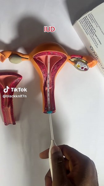 Mirena IUD: Effective Contraception for 10 Years