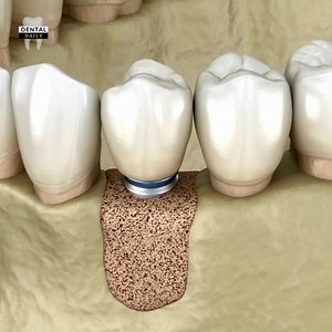 123K views · 1.1K reactions | Common dental procedures: 3D Animation | Dental Daily | Facebook
