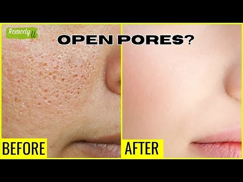 Open Pores Treatment: How to Close Pores Fast for Smooth, Clear Skin
