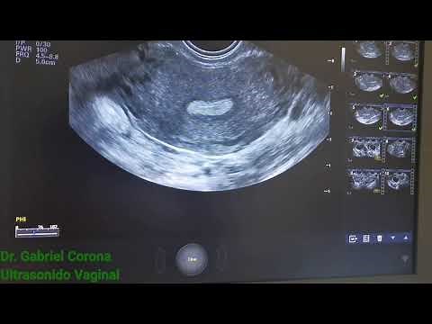 Vaginal Ultrasound