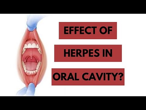 How does Herpes Effect Oral Cavity? Oral Manifestations of Systemic Diseases