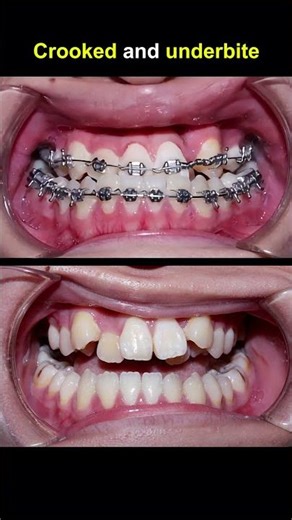 Extreme Tartar Removal ASMR | Deep Teeth Cleaning & Yellow Teeth Transformation