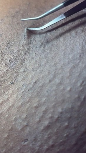 Close-Up Skin Texture Extraction with Tweezers