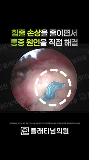 [플래티넘의원] 어깨힘줄파열 수술 봉합만으로 부족한 이유.