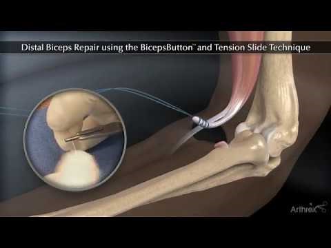 Réparation du Biceps distal au coude Dr Philippe Loriaut