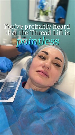 The Truth About Thread Lifts