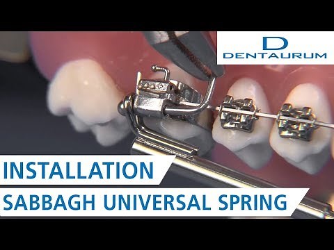 SUS installation - Sabbagh Universal Spring