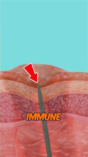 WHAT HAPPENS When A Splinter Gets Stuck Under Your Skin?