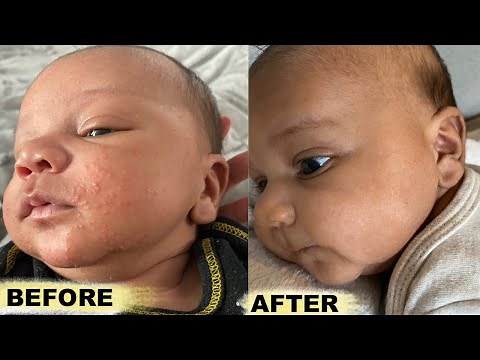How To Get Rid Baby Acne FAST!