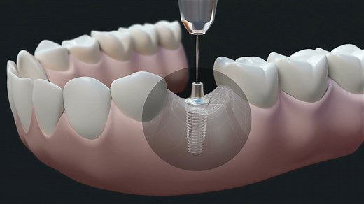 DENTAL IMPLANT DEMO VIDEO - Dental Hearts