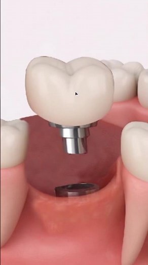 🔴 Split tooth | DENTAL IMPLANT PROCEDURE 3D ANIMATED