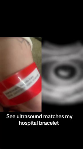 Understanding Fake Pregnancy: Insights from Social Media