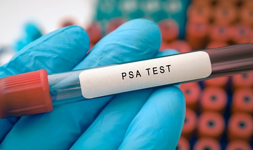 Dear Doctor: Does sexual activity affect PSA test results?