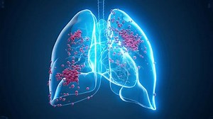 Conceptual animation of a lung cancer