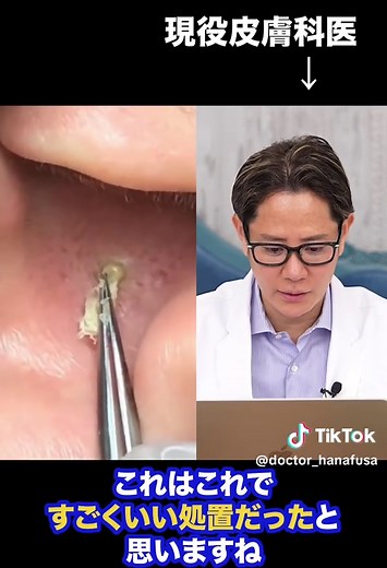 耳の粉瘤除去の素晴らしい手技