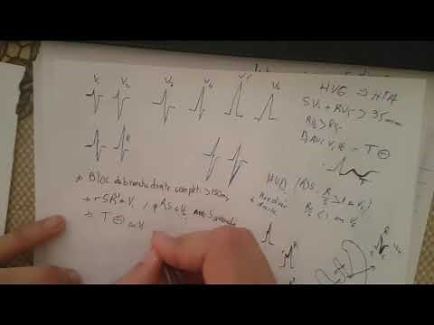 formation ECG : 20/ bloc de branche droit et gauche
