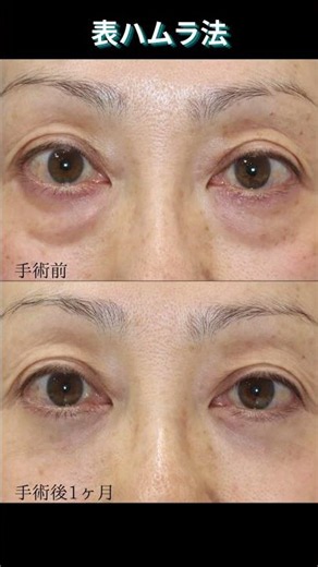 【50代／女性 下まぶたのたるみ取り】眼窩脂肪の膨らみが強い方に皮膚側から行う『表ハムラ法』で改善