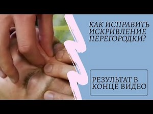 Как убрать искривление носовой перегородки?
