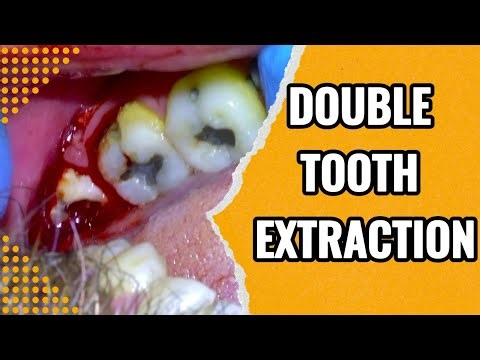 [94] Live Extraction of Grossly Decayed Wisdom Teeth