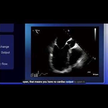 Detecting ROSC with TEE: What to Look For