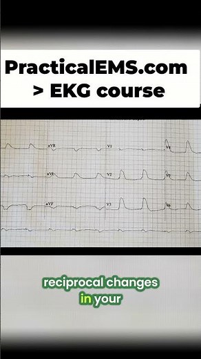 MI Pattern: See How a Heart Attack Looks Like On an EKG! #shorts
