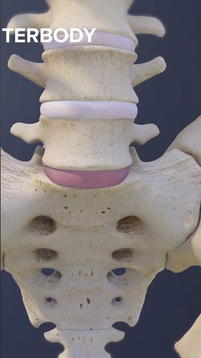 What Happens During an L5-S1 Anterior Lumbar Interbody Fusion?