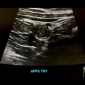 7.1K views · 164 reactions | Compress then measure the appendix!! . . . . . . . . . #ultrasound #radiology #imaging #ultrasonido #medical #medicine #ultras #ultrasonography #mri #xray #doppler #health #radiologist #healthcare #ultrason #loveultrasound #nursing #sonography #vascular | John Z Wetmore | Facebook