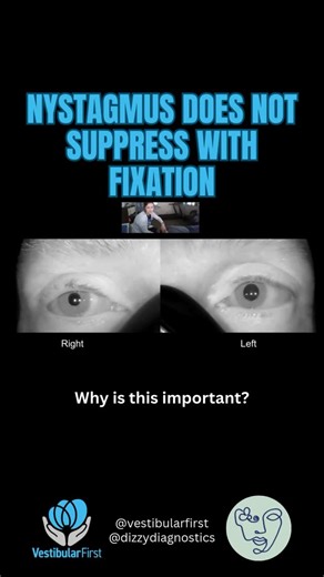 🚨Nystagmus doesn’t suppress with fixation? It’s likely due to brain pathology! (A long case, but stay with me) This patient experienced a sudden onset of dizziness and hearing loss and was diagnosed with labyrinthitis. Imaging was normal, and he was referred to ENT for hearing loss care and vestibular therapy for eval and treat of vertigo and imbalance. Vestibular PT evaluation revealed central findings: ‼️ Direction-changing nystagmus with gaze ‼️ Vertical skew deviation ‼️ Unilateral pupillar