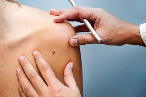 How to check moles for signs of skin cancer