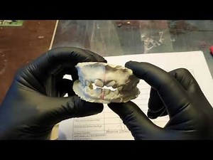 ANÁLISIS DE MODELOS EN ORTODONCIA (MOYERS)