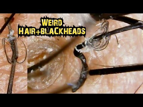 The weirdest Ingrown Hair+Blackheads Extraction