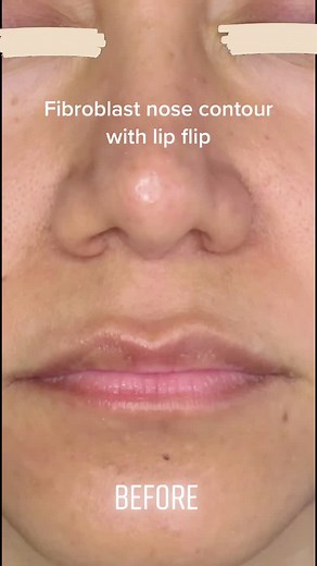 Nose Contour and Lip Refinement with Fibroblast Plasma Pen