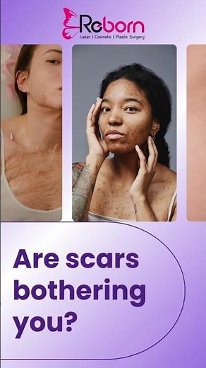 Are Scars from Acne, Burns, or Surgery Bothering you?