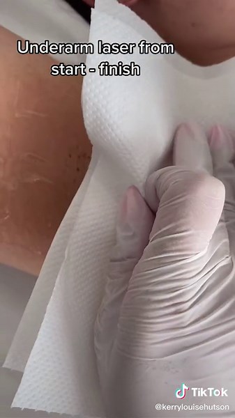 Holistic Process of Underarm Laser Hair Removal at Shiny Laser Clinic