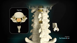 Cervical Laminectomy without Fusion