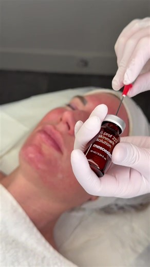 The Benefits of Combining Peeling and Microneedling